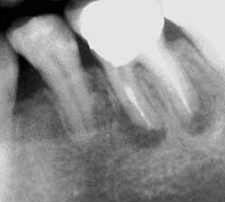 歯内療法の臨床例 - 急性根尖性歯周組織炎