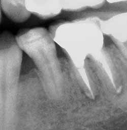 歯内療法の臨床例 - 急性根尖性歯周組織炎