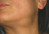 顎下腺炎の症例