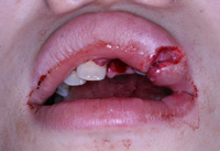 口唇の裂傷の症例