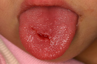 舌の裂傷の症例
