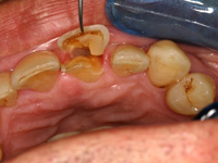 歯冠破折の症例